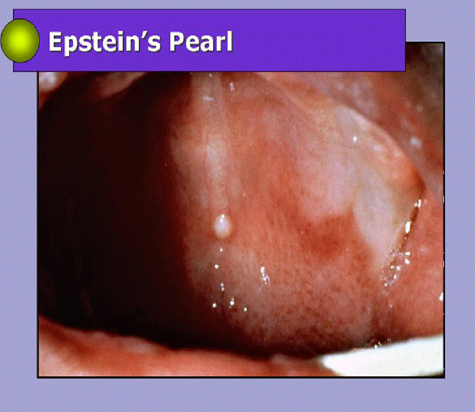 epstein pearl