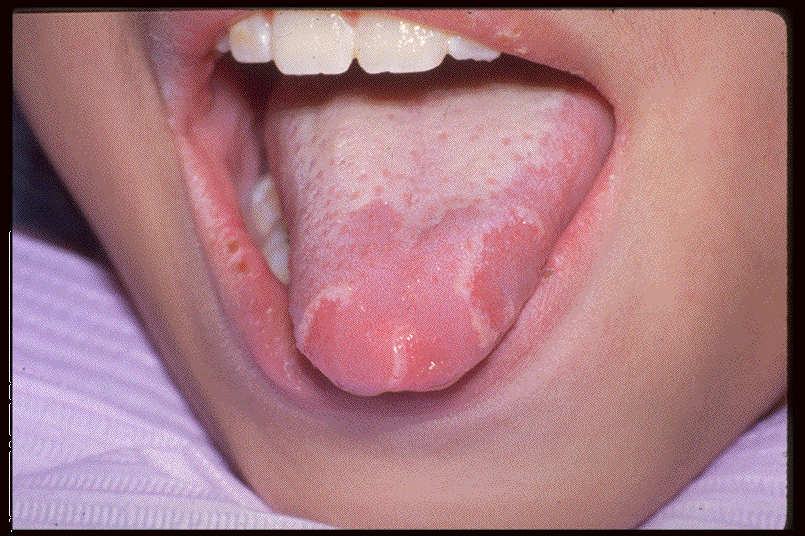 Marks On Toddlers Tongue