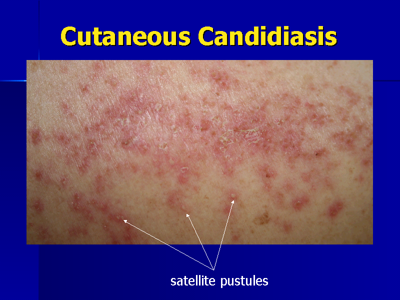 cutaneous-candidiasis