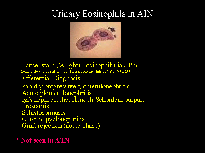 Urinary Eosinophils in AIN