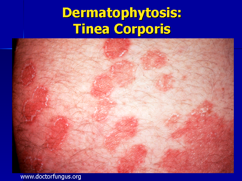 Dermatophytosis: Tinea Corporis